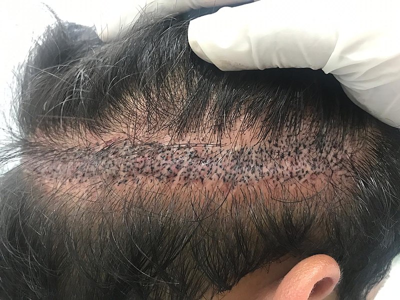 the main image - scalp micro pigmentation for hair