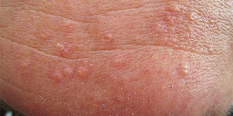 the main image - cryotherapy warts